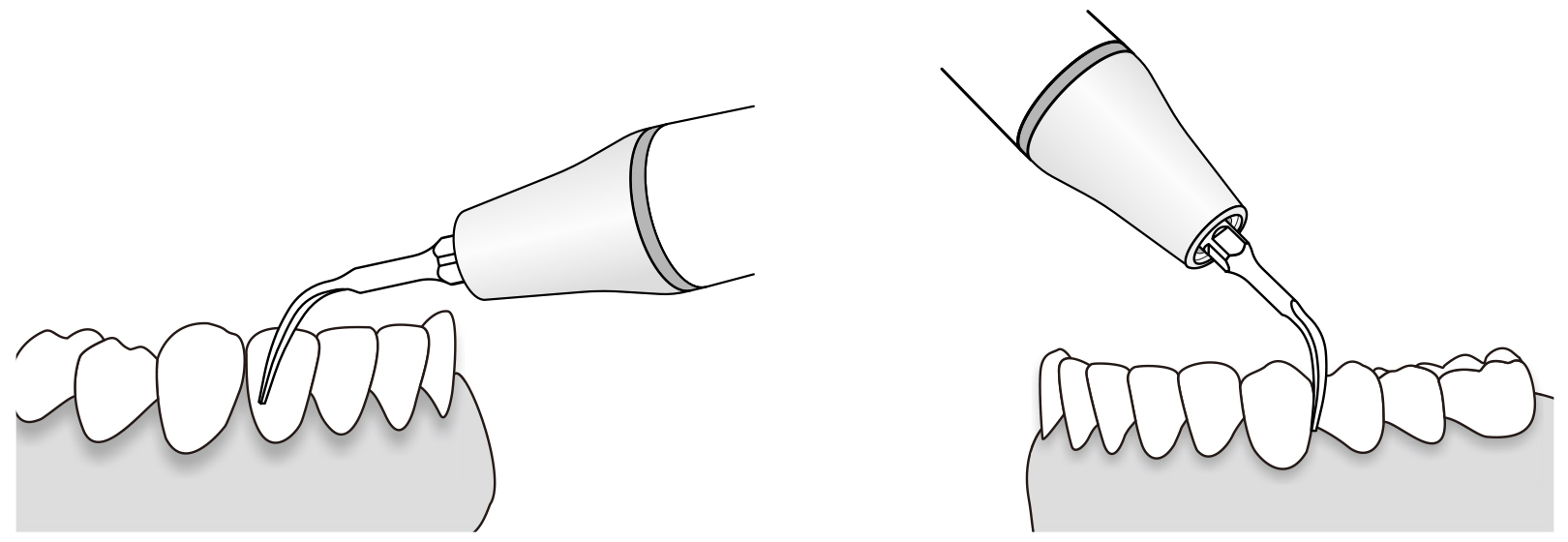 Сфера применения наконечника для скалера